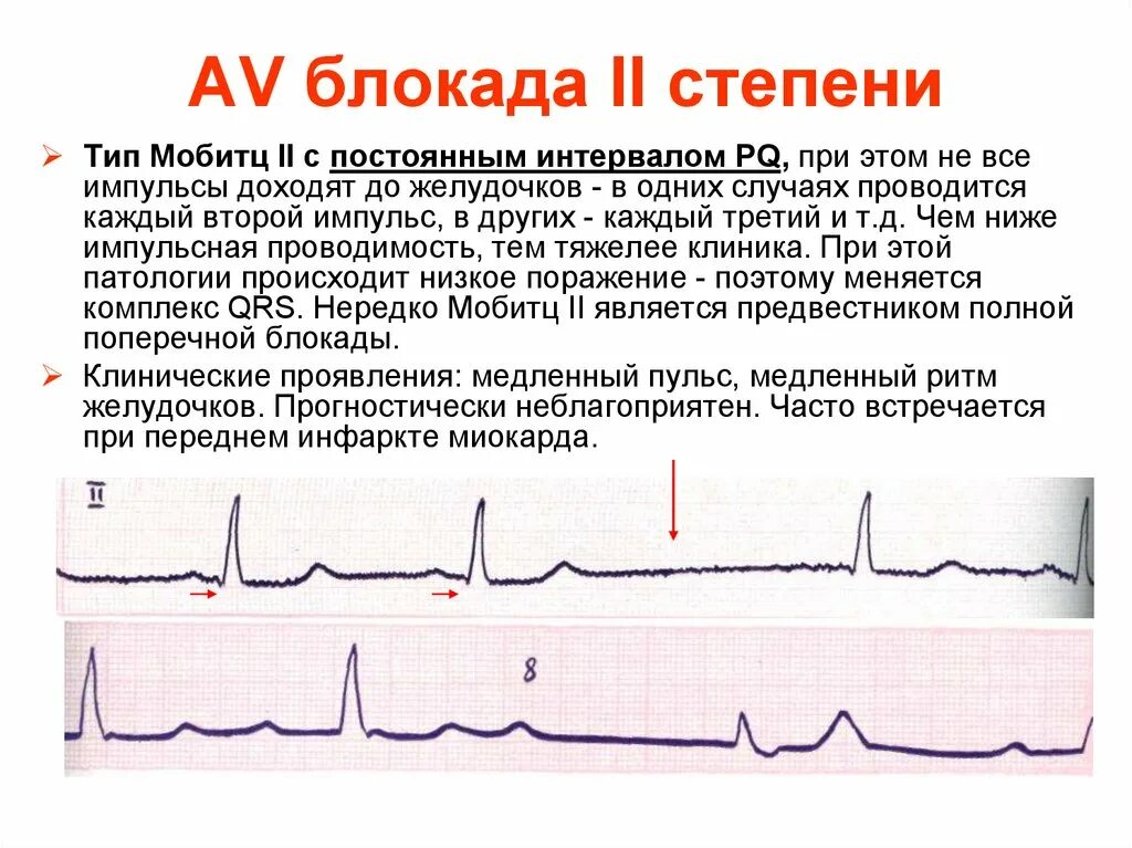 Атриовентрикулярная блокада 2. АВ блокада 2 степени Мобитц 2 на ЭКГ. Атриовентрикулярная блокада 2 степени Мобитц 2 на ЭКГ. АВ блокада 2 степени Мобитц 3 на ЭКГ. АВ блокада 2 Мобитц 1 на ЭКГ.