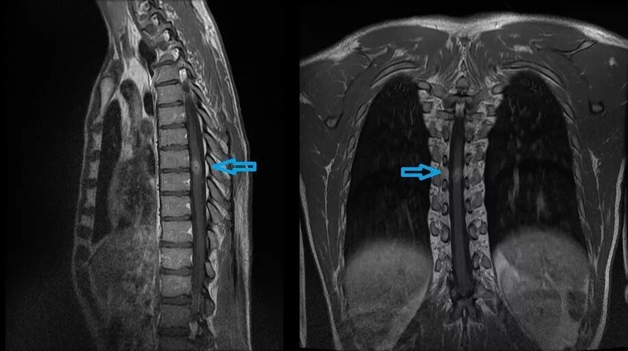 Опухоль позвоночника грудного отдела на мрт. Опухоль спинного мозга мрт. Интрамедуллярная опухоль спинного мозга мрт. Опухоль спинного мозга эпендимома. Интрамедуллярные опухоли спинного