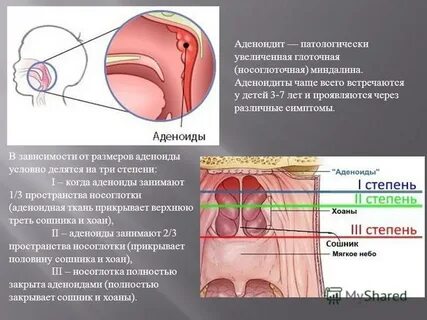 Степени аденоидита у детей