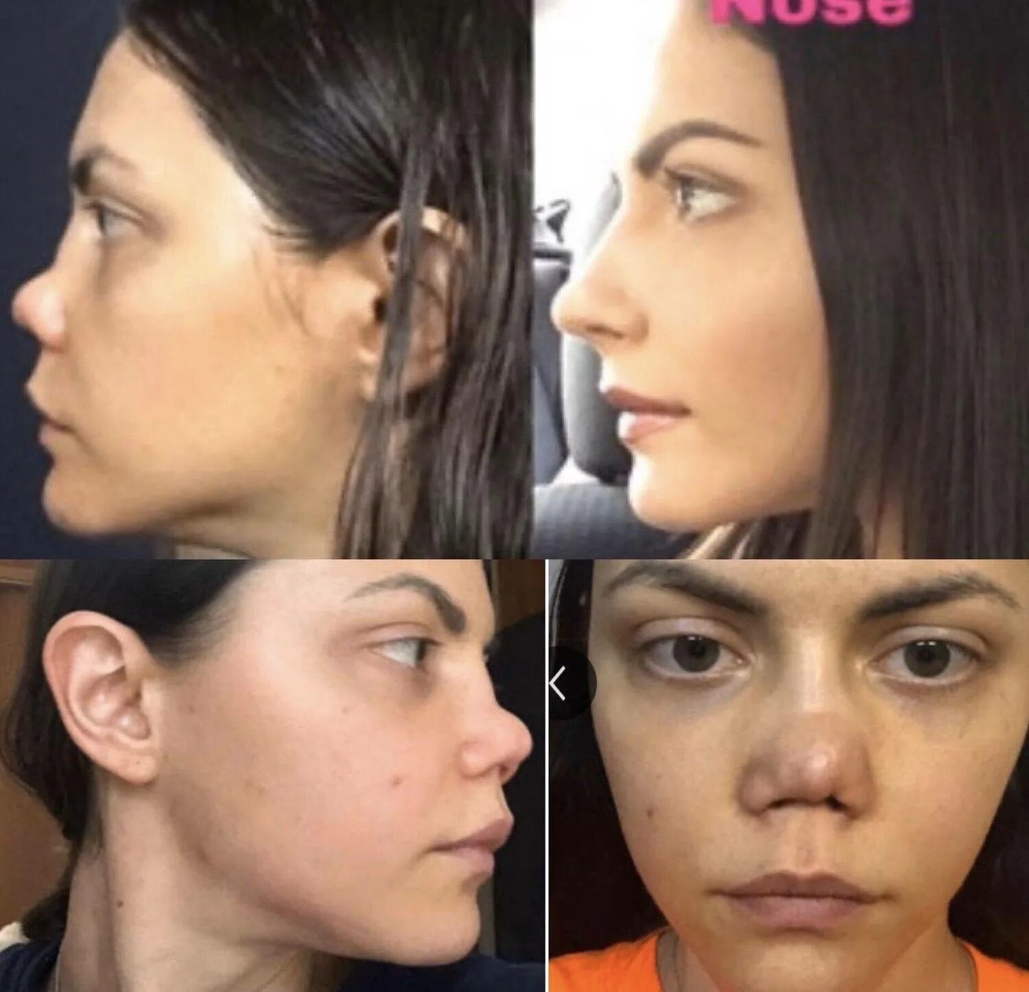 пластика лица нос