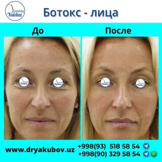 Как нейтрализовать ботокс