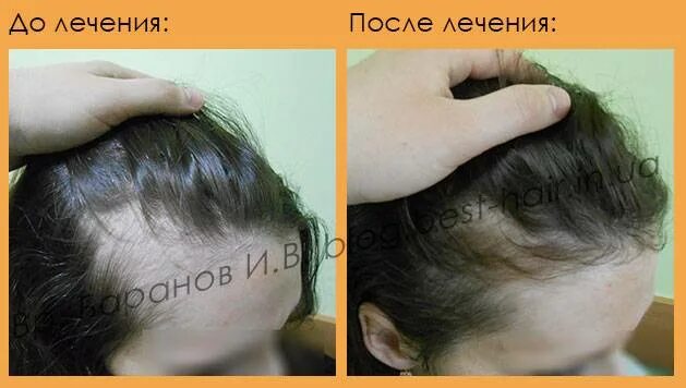 Почему после родов выпадают. Выпадение волос после родов. сильно выпадают волосы после родов. послеродовое выпадение волос. послеродовая алопеция.