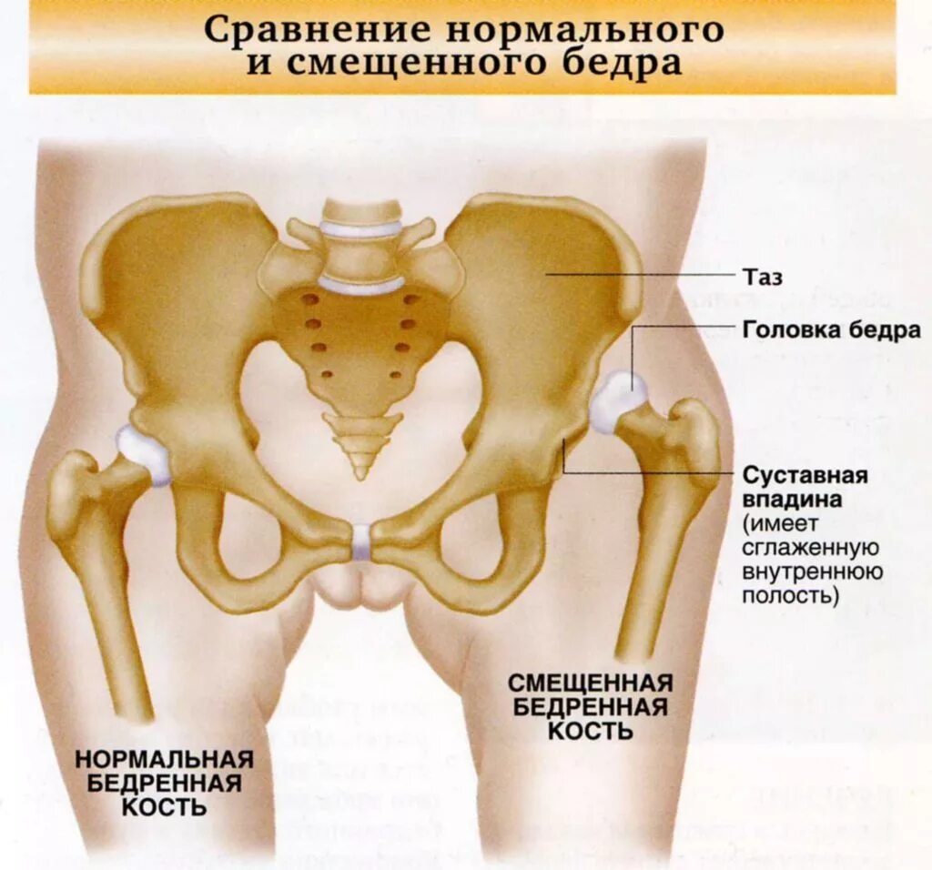 Дисплазия вывих тазобедренного сустава. Врожденный вывих тазобедренного сустава. Подвздошная кость суставная впадина. Вывих и подвывих тазобедренного сустава.