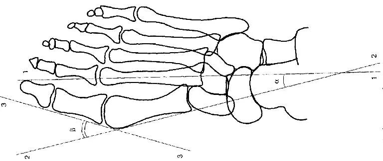 Поперечное 1 степени. Поперечное плоскостопие рентген степени. Поперечное плоскостопие рентген измерение. Продольно поперечное плоскостопие рентген. Плоскостопие поперечное схема рентген.