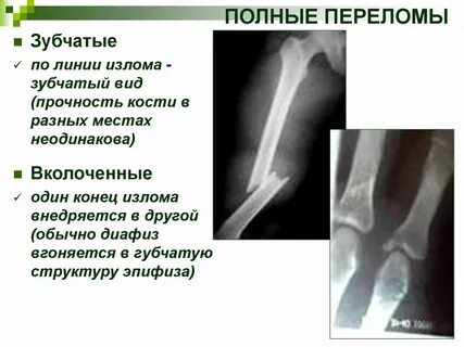 Перелом при котором линия перелома начинается