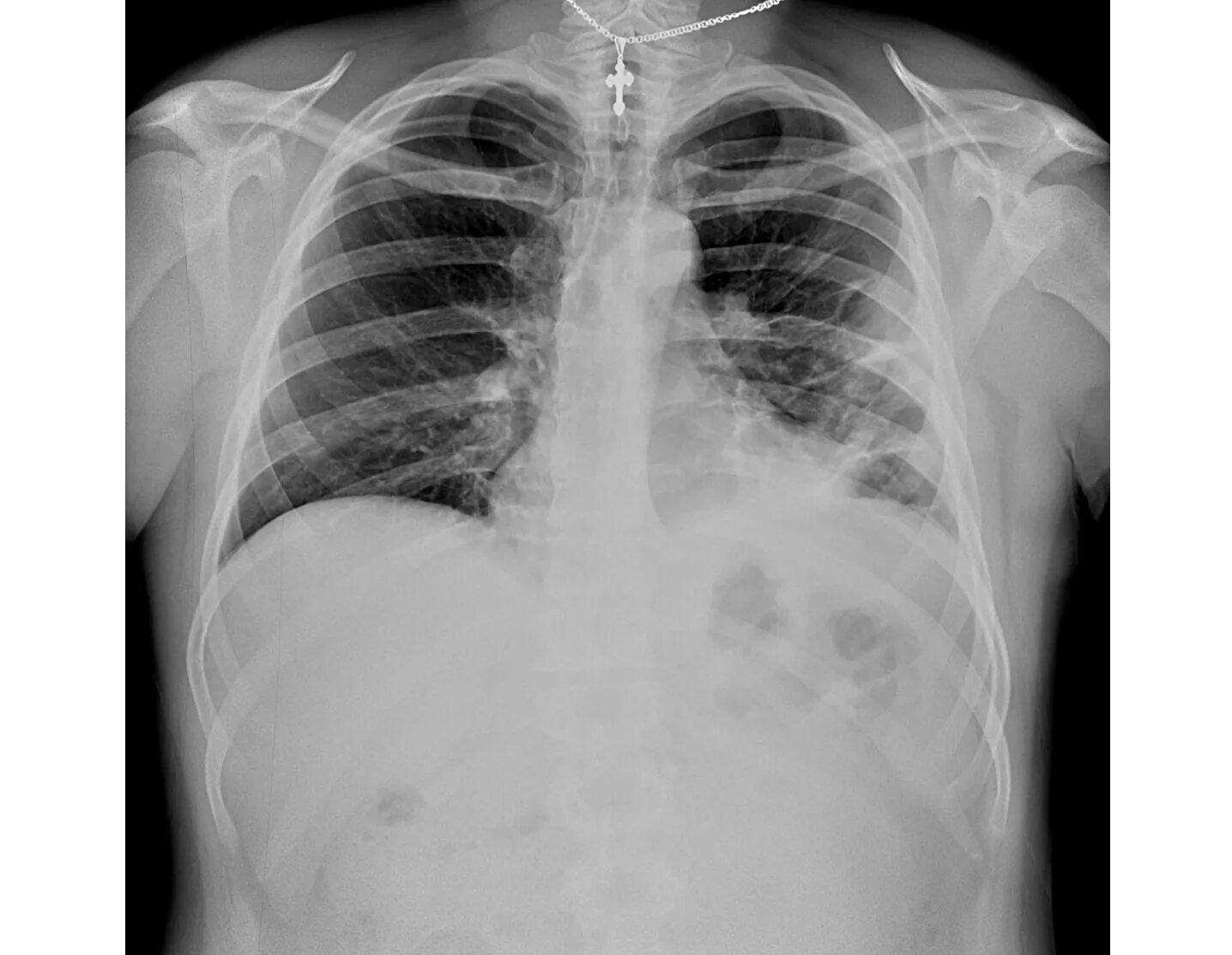 Поражение легкого 50. Коронавирус пневмония рентген. Легкие на рентгене при коронавирусе. Снимок лёгких при коронавирусе. Рентген легких лежа.