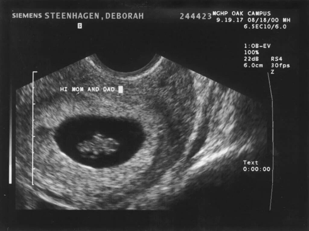 Замершая беременность 18 недель. Анэмбриония тесты динамика. Омывание плода на ранних сроках симптомы.