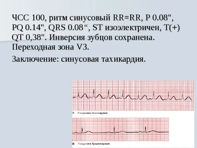 Чсс мс. Кардиограмма заключение ритм синусовый. чсс 102 ритм синусовый. заключение экг синусовый ритм норма. экг синусовая тахикардия заключение.