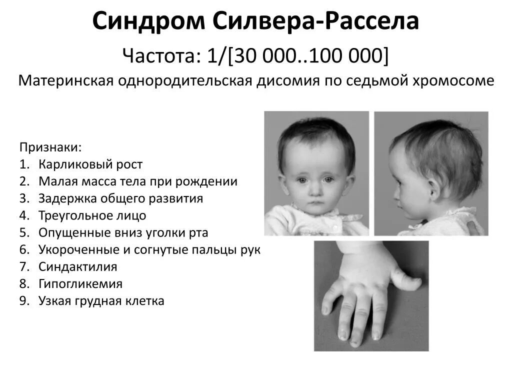 Синдром дауна трисомия 21 хромосомы. Мкб 10 внебольничная двусторонняя пневмония. Коды мкб 10. Синдром дауна этиология. Мозаичный синдром дауна кариотип.