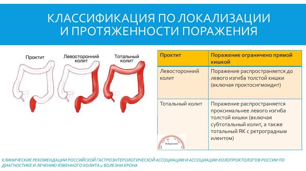 Языенный колит монреальсуая уоасифиуация. Неспецифический язвенный колит классификация. Классификация язвенного колита по локализации. Язвенный колит локализация. Лечение проктита прямой