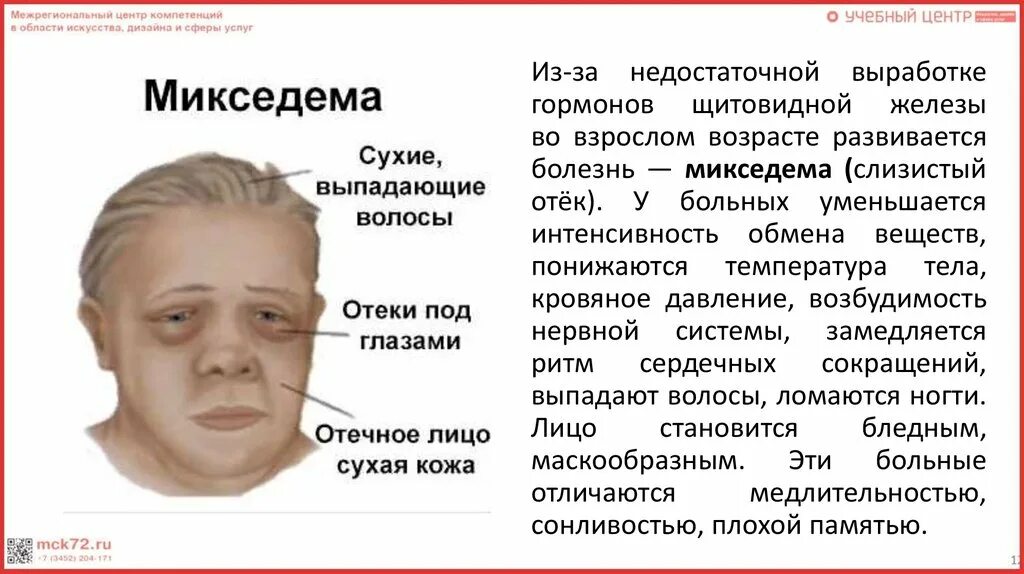 Микседема слизистый отек. Микседема что за болезнь