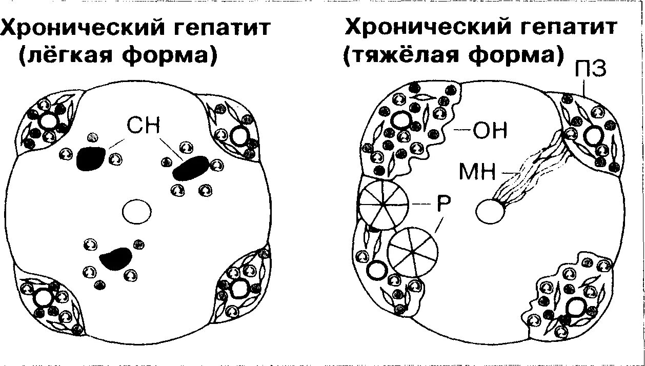 Интегративный гепатит. Формы хронического гепатита. виды хронического гепатита. хроническая форма гепатита б. острая и хроническая формы гепатита.