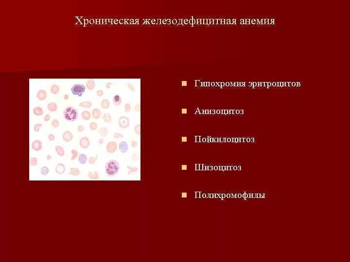 Пойкилоцитоз анемия. Железодефицитная анемия анизоцитоз пойкилоцитоз. Железодефицитная анемия гипохромия. При железодефицитной анемии гиперхромия эритроцитов.