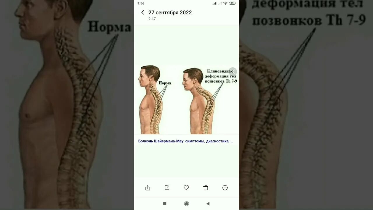 Болезнь шейермана мау что это такое. Юношеский кифоз болезнь Шейермана-МАУ. Болезнь Шейермана МАУ корсет. Болезнь Шейермана МАУ фото.