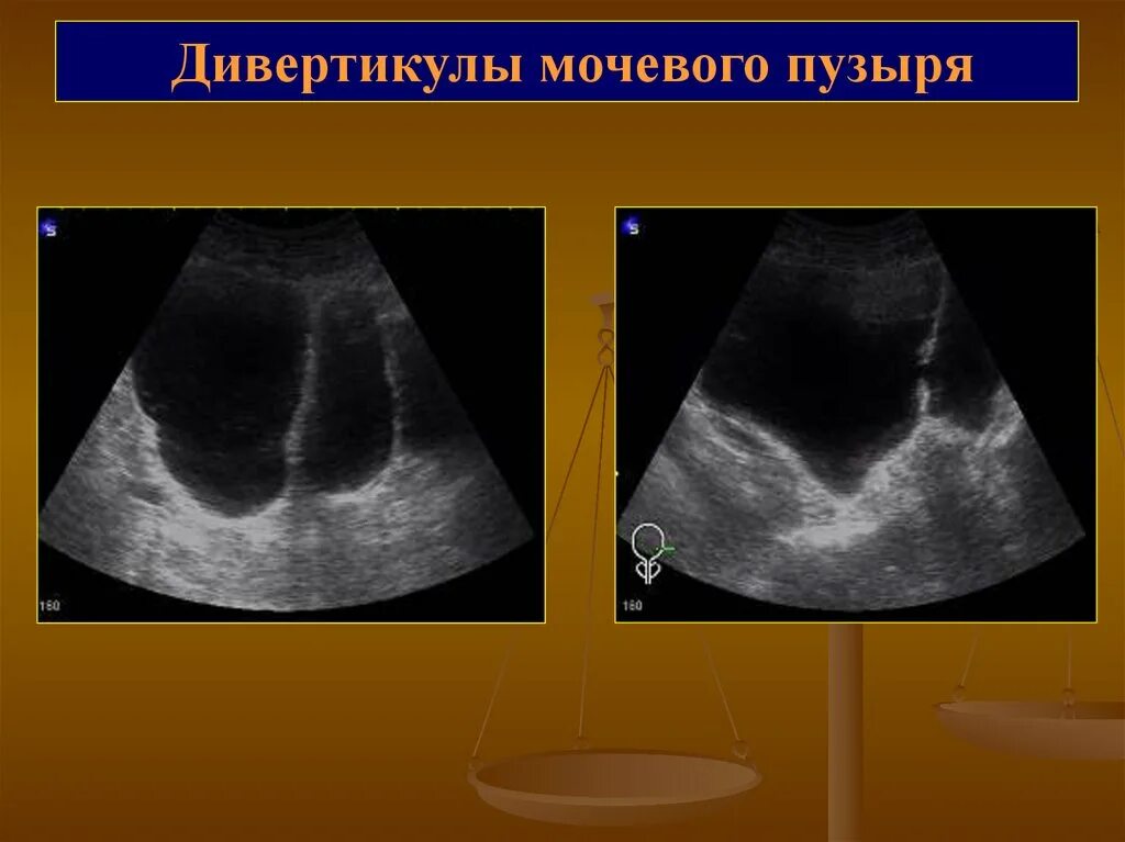 Дивертикул мочевого пузыря на УЗИ. Дивертикулёз мочевого пузыря на УЗИ. Псевдодивертикулез стенок мочевого пузыря. Патология мочевого пузыря на УЗИ.