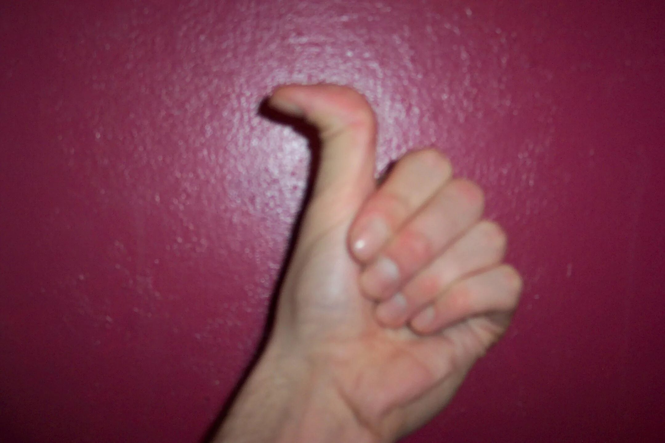 Гиперподвижность суставов дисплазия соединительной ткани. Большой палец. Большой палец сгибается. Загнутый большой палец. Большой палец изгиб