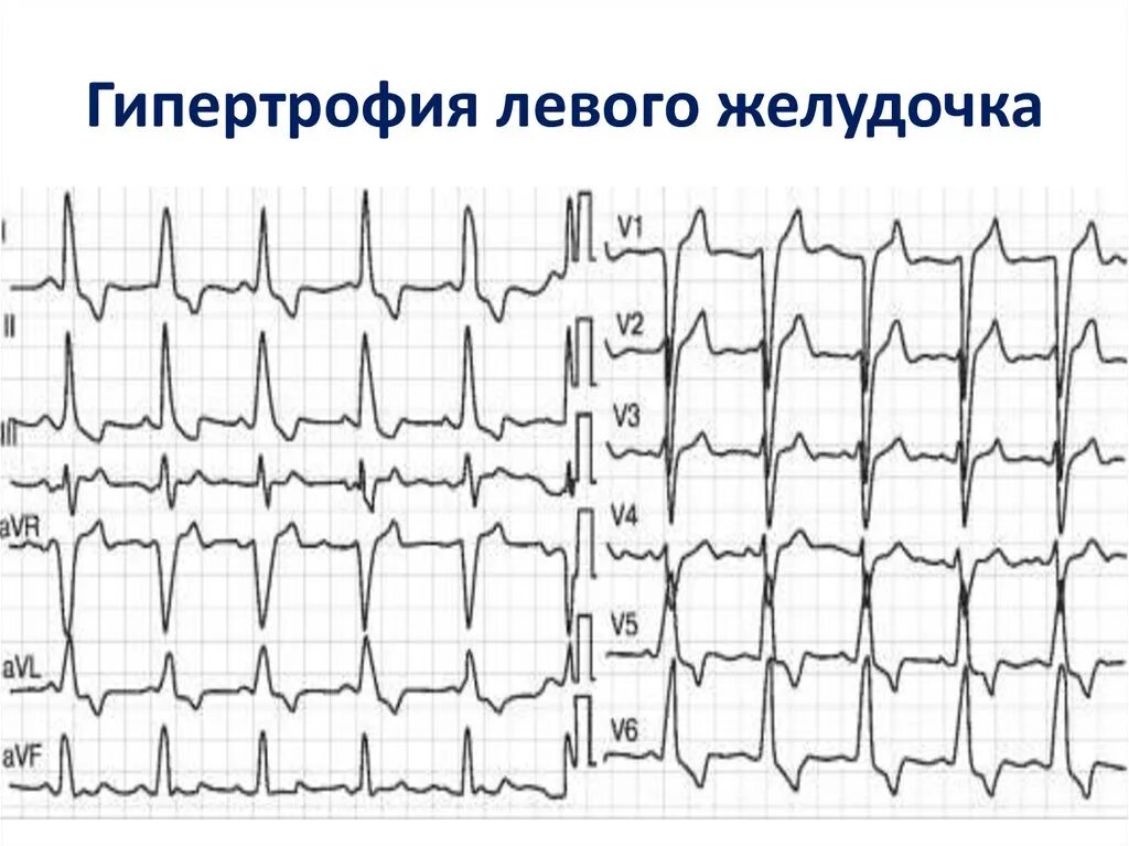 Гипертрофия левого желудочка на ЭКГ. Гипертрофия миокарда левого желудочка на ЭКГ. Гипертрофия миокарда левого желудочка сердца на ЭКГ. Гипертрофия лж на ЭКГ. Гипертрофия левого предсердия левого желудочка