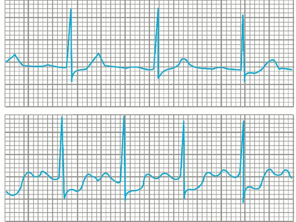 Болезни на экг. Ишемия миокарда на ЭКГ. ЭКГ при ИБС. ЭКГ при хронической ишемической болезни сердца. Ишемическая болезнь кардиограмма.