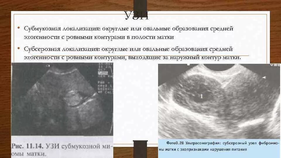 Полость матки деформирована. УЗИ критерии миомы матки. Миома матки на УЗИ описание. Миома и беременность на УЗИ. Кальцинированная миома матки на УЗИ.