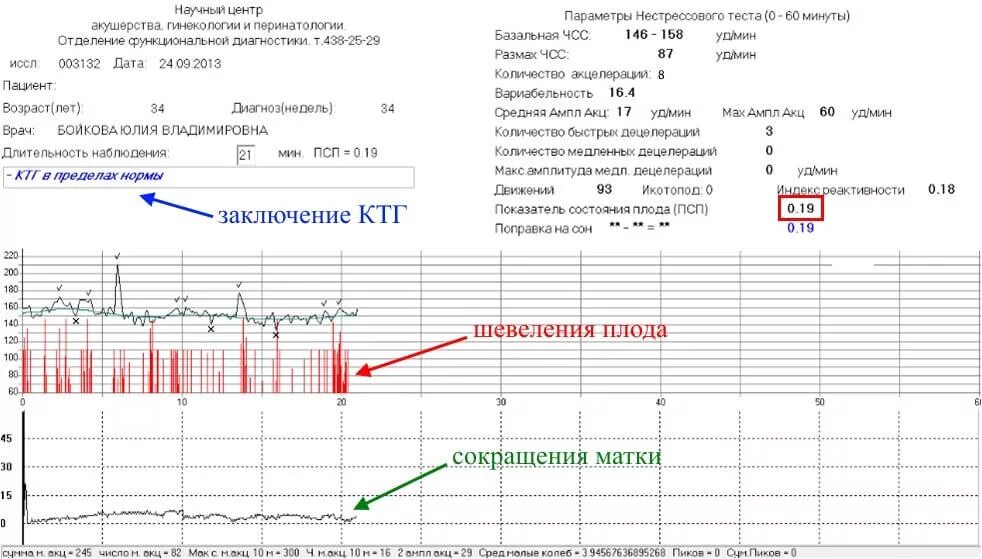 Исследование сердцебиения плода. КТГ У беременных расшифровка норма. Нормальные показатели КТГ плода. КТГ интерпретация результатов. Нормальная диаграмма КТГ.