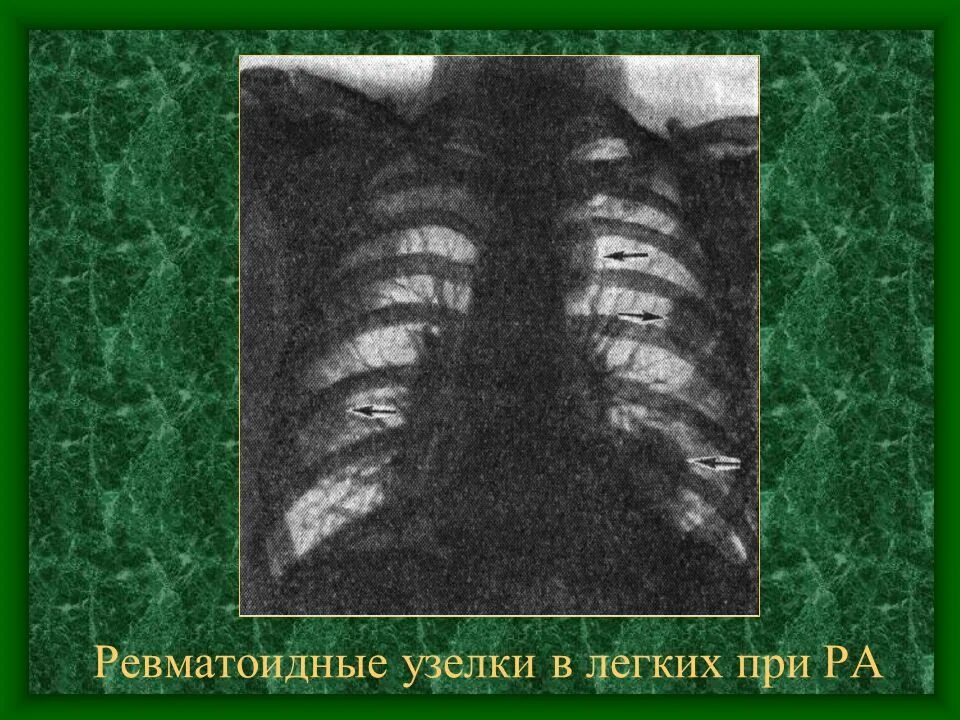 Ревматоидный артрит легких. Подкожные ревматические узелки. Ревматоидные узлы в легких. Поражение легких при ревматоидном артрите кт.