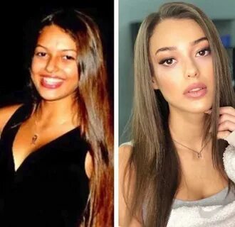 Чичек дениз до и после пластики Чичек дениз после пластики