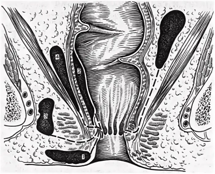Трещины прохода. Пельвиоректальный парапроктит. Интрасфинктерный парапроктит.