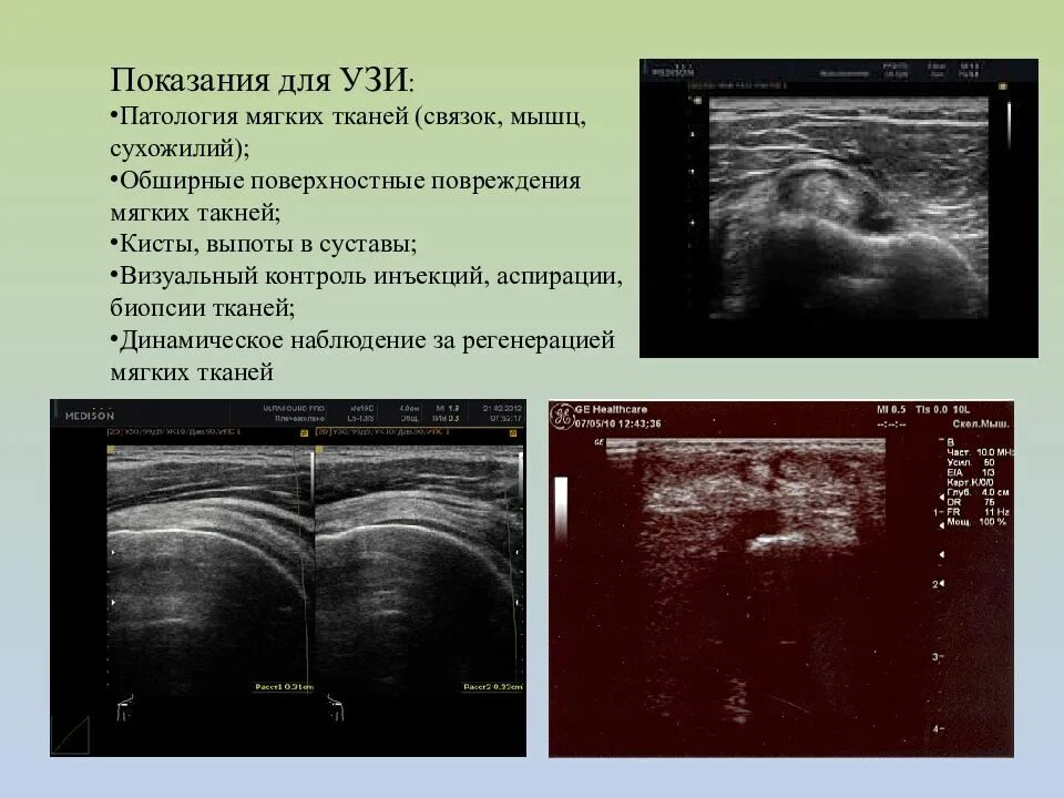 Узи аномалий. Фиброма мягких тканей на узи. инфильтрат мягких тканей узи картина. узи абсцесса мягких тканей протокол. саркома мягких тканей на узи.