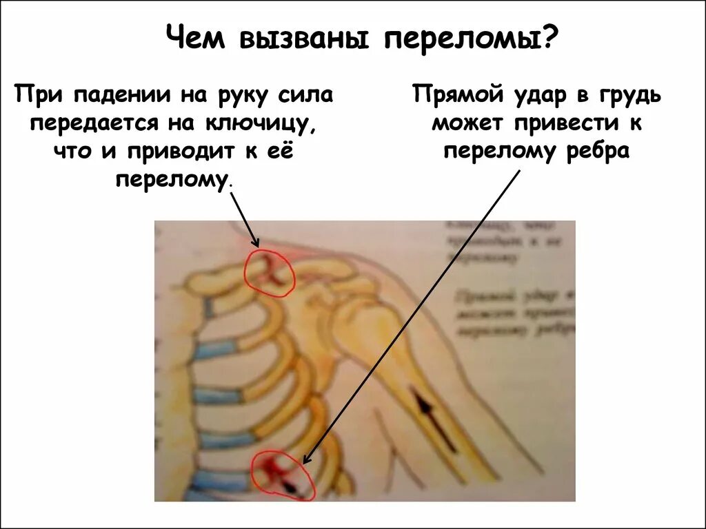 Коренной перелом. Оказание первой помощи при травмах. Основные и дополнительные методы исследования переломов. Коренной перелом карикатура. Что делать при переломе руки.