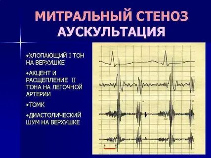Диастолический тон