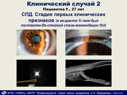 Спазм аккомодации мкб 10 у детей код