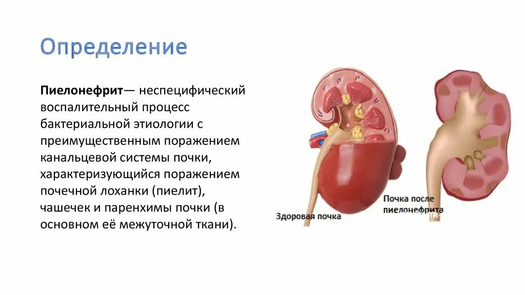 Пиелонефрит у детей какие. Пиелонефрит поражение почечной лоханки. Полинифрит почек хронический пиелонефрит. Хронический пиелонефрит 3. Пиелонефрит неспецифический воспалительный процесс с поражением.