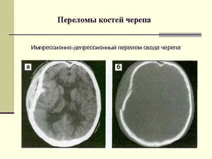 Импрессионный перелом кости