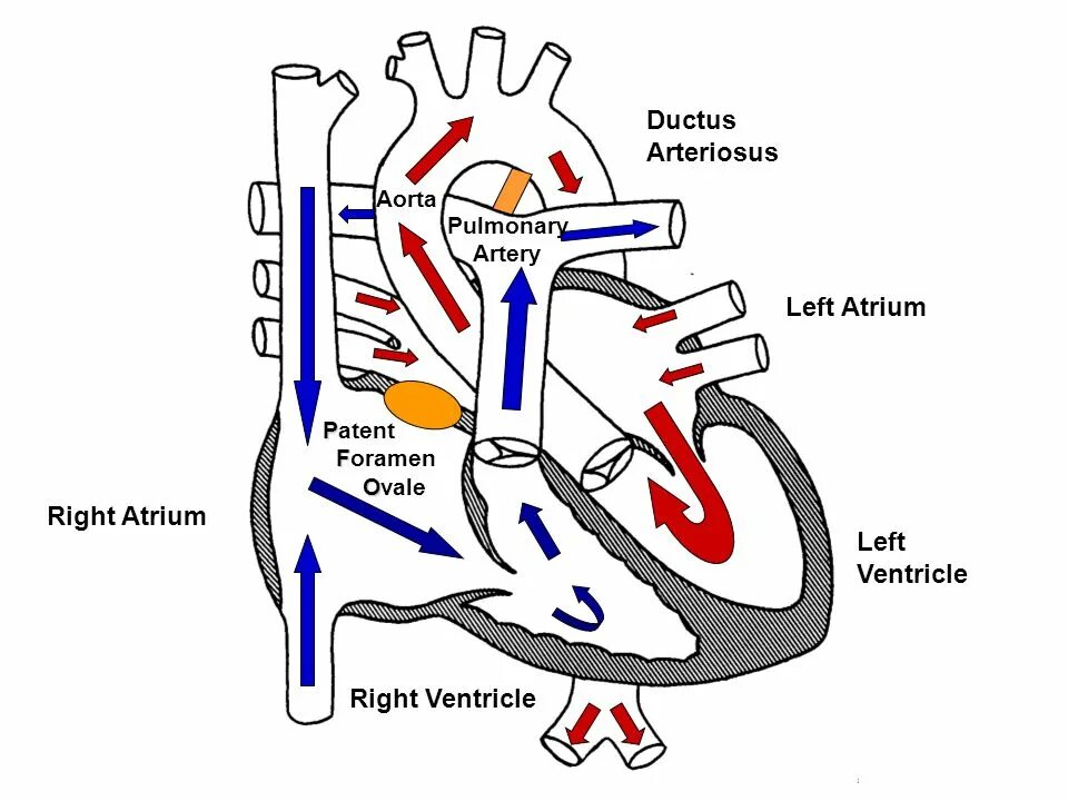 Plexus arteriosus. Patent ductus arteriosus. дуктус артериозус. large patent ductus arteriosus. patent arterial ductus.
