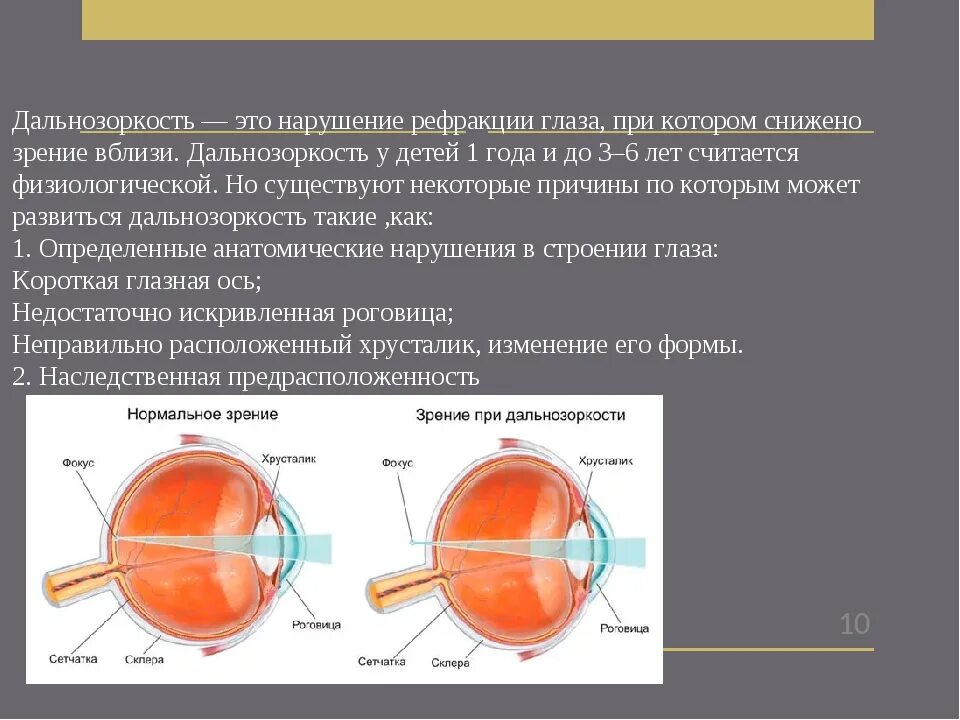 Операция при дальнозоркости. Гиперметропия рефракция. Острота зрения. Рефракция. Аккомодация.. Эмметропия миопия гиперметропия. Нарушения рефракции глаза близорукость дальнозоркость.