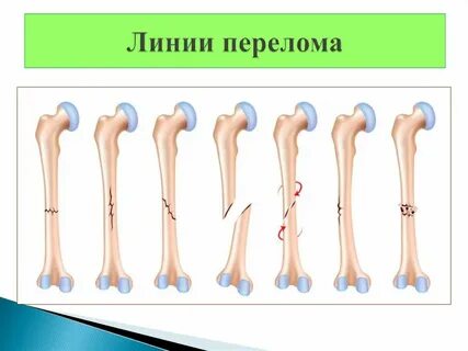 Линия перелома прослеживается