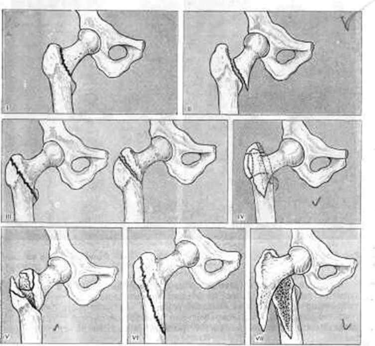 Вертельный перелом тазобедренного сустава. Чрезвертельно-подвертельный перелом. Вертельный перелом шейки бедра. Чрезвертельный перелом бедренной кости остеосинтез.