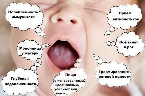 Белое пятнышко у грудничка на деснах, во рту и на языке