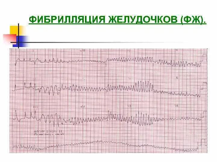 На ЭКГ мелковолновая фибрилляция. Фибрилляция желудочков на ЭКГ. Мелковолновая фибрилляция желудочков ЭКГ. Крупноволновая фибрилляция желудочков на ЭКГ.