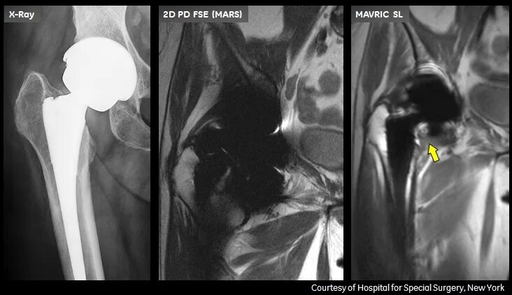 Мрт после эндопротезирования. Эндопротез тазобедренного сустава мрт. Мрт после эндопротезирования тазобедренного сустава. МР томография тазобедренного сустава.