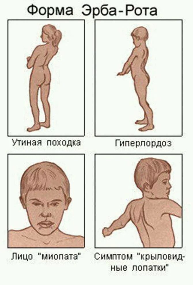 Ген дистрофии. Прогрессирующая мышечная дистрофия у детей эрба рота. симптомы миодистрофии эрба-рота. мышечная дистрофия дюшенна признаки. болезнь миопатия эрба рота.