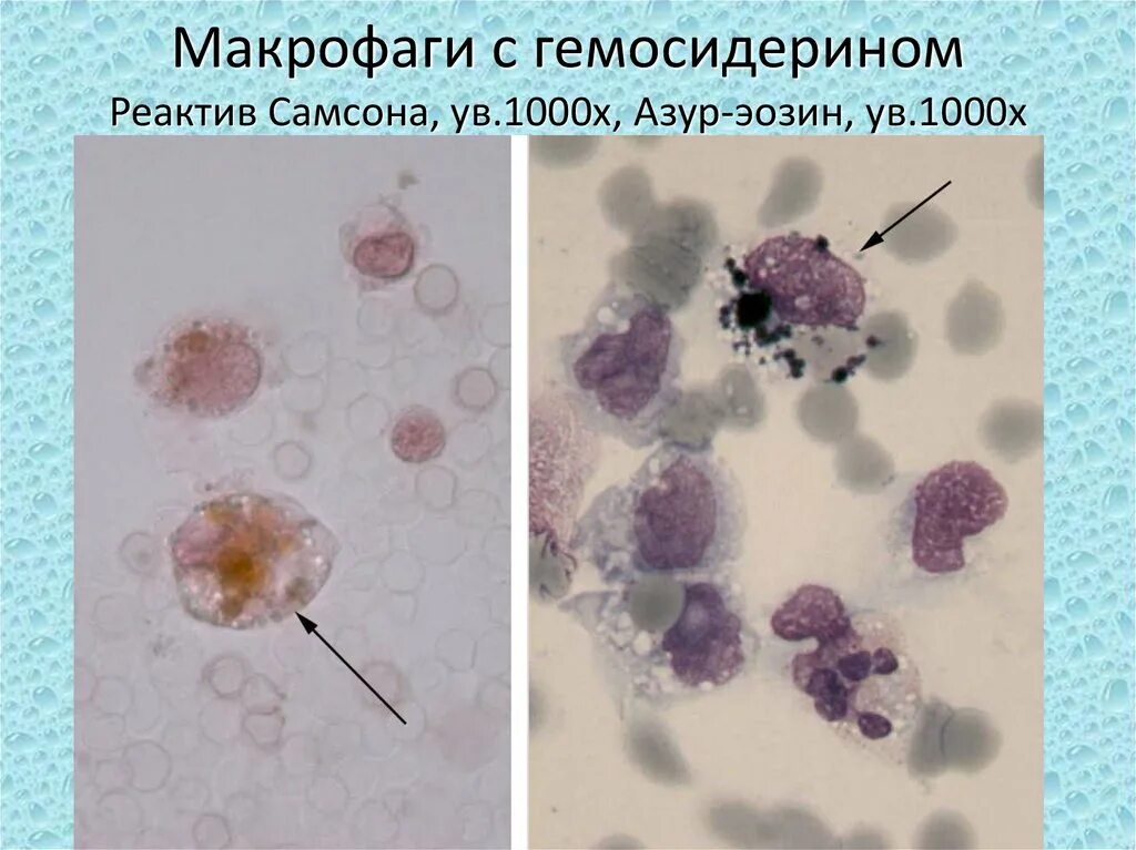 Макрофаги в молочной. Макрофаг с гемосидерином в ликворе. Микроскопическое исследование мокроты альвеолярные макрофаги. Альвеолярные макрофаги в мокроте микроскопия. Альвеолярные макрофаги с гемосидерином в мокроте.