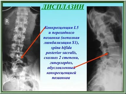 Конкресценция