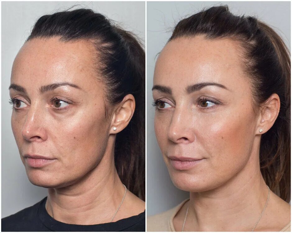 Филлеры через сколько спадают отеки