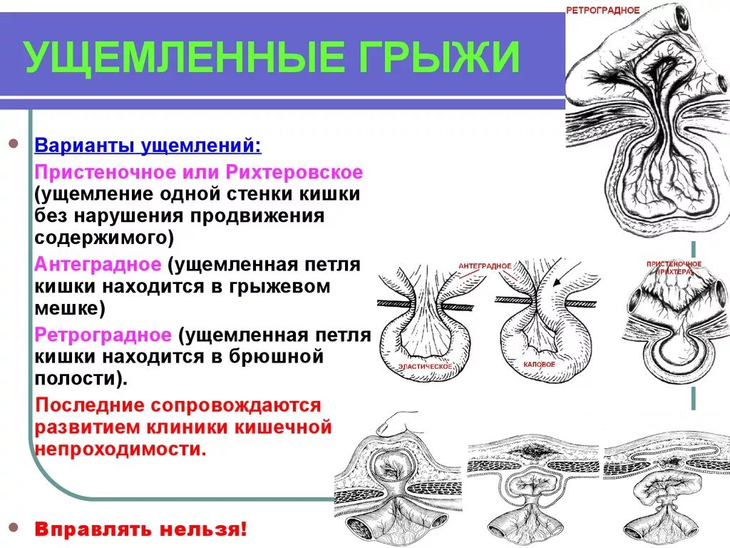 Вызов внешнего ущемления. Механизм калового ущемления грыжи. пристеночное рихтеровское ущемление.