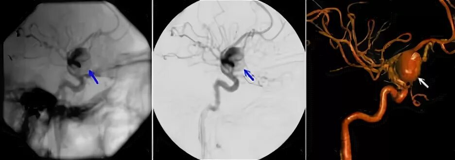 Аневризма сонной артерии что это. Супраклиноидная аневризма. Супраклиноидный отдел ВСА аневризма. Супраклиноидный отдел внутренней сонной артерии на кт. Аневризма супраклиноидного отдела левой ВСА.