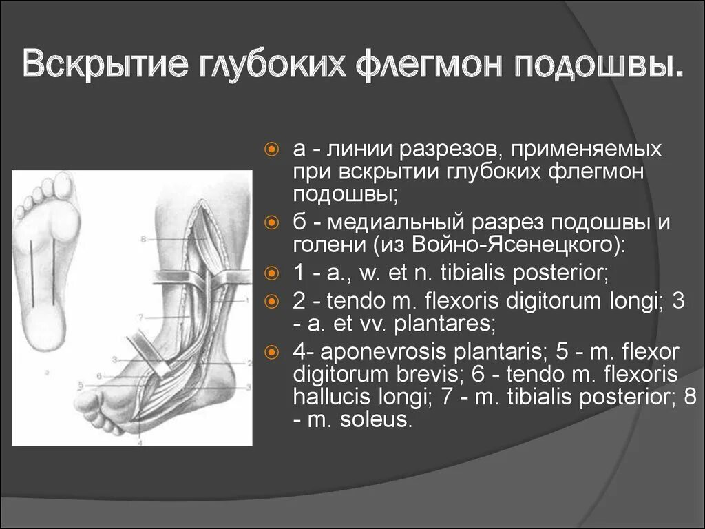 Вскрытие флегмон подошвы. Посттравматическая флегмона голени. Код мкб 10 флегмона нижних конечностей. Флегмона голени клиника. Рана стопы по мкб 10