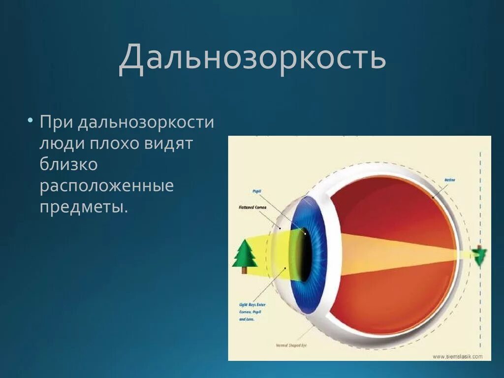 Дальнозоркость что делать. Дальнозоркость. Человек с дальнозоркостью. Болезнь дальнозоркость. Приобретенная дальнозоркость.