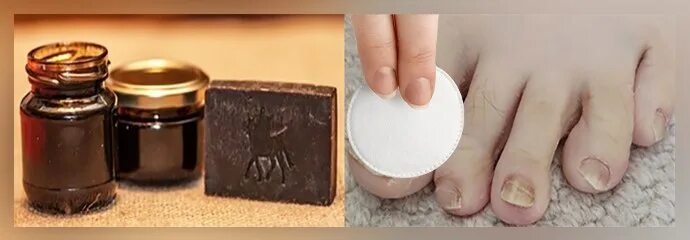 Березовый деготь от грибка ногтей на ногах. Ванночки для ногтей от грибка. ванночки для ног от грибка с дегтем. ванночка для ногтей с хозяйственным мылом.