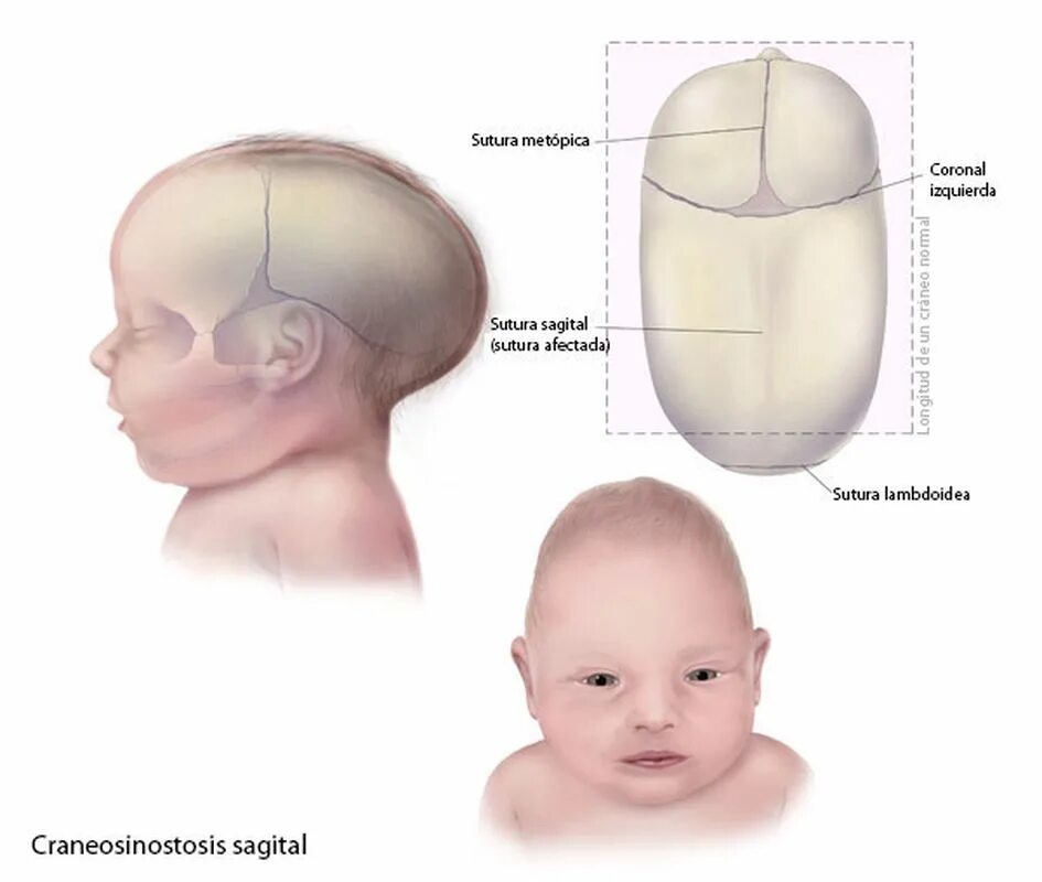 Сагиттальный шов черепа новорожденного. Краниостеноз формы черепа. Форма головы сбоку младенца. Коронарный краниостеноз.